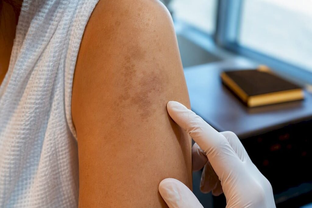 Zone de peau hyperpigmentée après traitement au laser